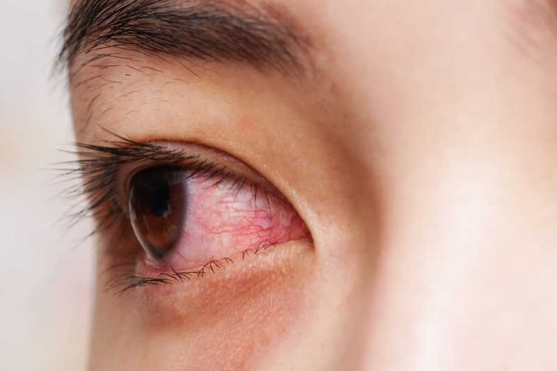 The Symptoms of Dry Eye